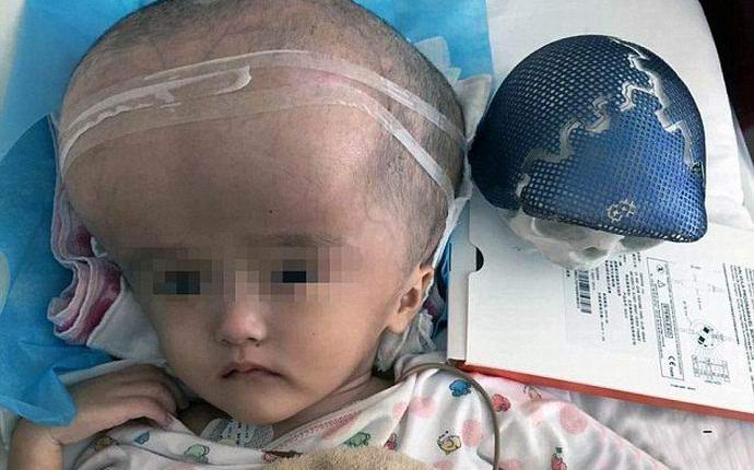 Un crâne imprimé sur une imprimante a d'abord été implanté dans un homme.