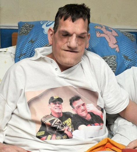En raison du syndrome de Proteus, un homme a atteint une hauteur de 240 centimètres