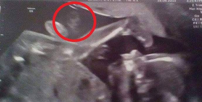 Un fantôme d'une grand-mère est apparu sur une image échographique d'un enfant