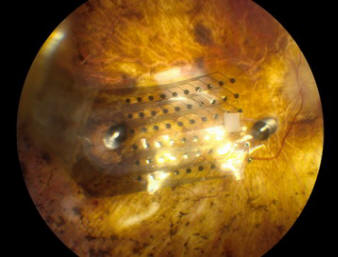 argus-II-implant-rétinien-640x538