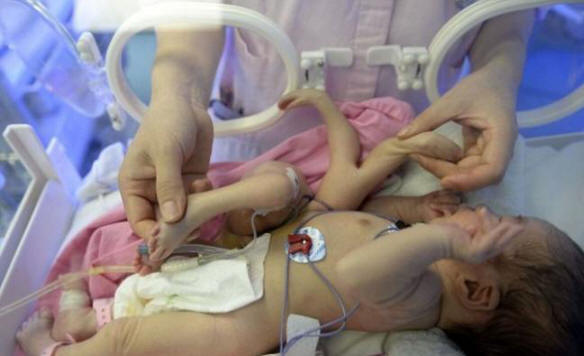 En Chine, le garçon a été coupé des bras et des jambes supplémentaires